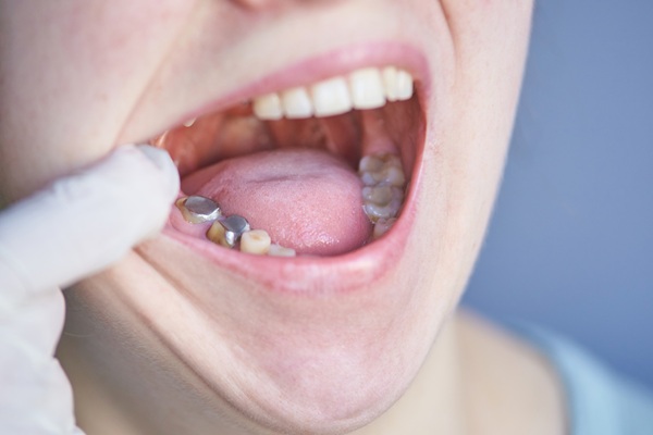 Old Dental Fillings? Common Signs You May Need A New One